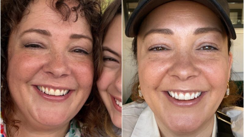 snow teeth whitening before and after