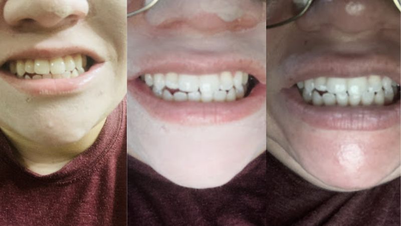 snow teeth whitening